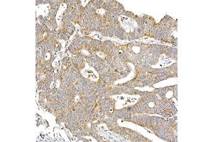 Immunohistochemistry of paraffin-embedded human colon carcinoma using S Rabbit mAb (ABIN7270501) at dilution of 1:250 (40x lens).