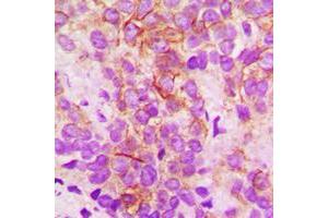 Immunohistochemical analysis of Cytochrome P450 2B6 staining in human breast cancer formalin fixed paraffin embedded tissue section. (CYP2B6 Antikörper  (Center))