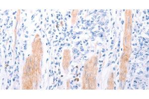 Immunohistochemistry of paraffin-embedded Human gasrtic cancer tissue using LPAR2 Polyclonal Antibody at dilution 1:40 (EDG4 Antikörper)