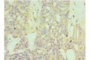 Immunohistochemistry of paraffin-embedded human endommetrial cancer using ABIN7155969 at dilution of 1:100 (HYAL1 Antikörper  (AA 136-435))