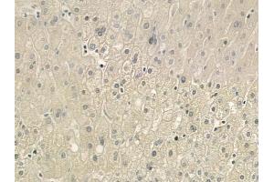 ABIN6264775 and ABIN6276503 at 1/100 staining human gastric carcinoma by IHC-P. (RNASE11 Antikörper  (Internal Region))