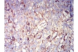 Immunohistochemical analysis of paraffin-embedded bladder cancer tissues using CD44 mouse mAb with DAB staining. (CD44 Antikörper  (AA 36-194))