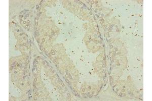Immunohistochemistry of paraffin-embedded human prostate cancer using ABIN7168124 at dilution of 1:100 (RPP25L Antikörper  (AA 1-163))