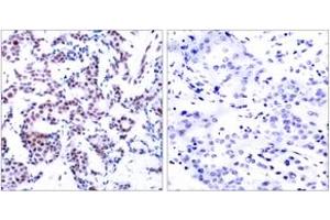 Immunohistochemistry analysis of paraffin-embedded human breast carcinoma, using JunB (Phospho-Ser259) Antibody. (JunB Antikörper  (pSer259))