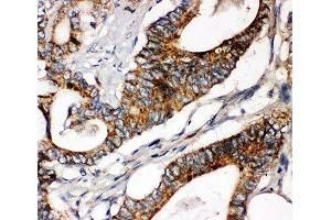 IHC-P: Laminin gamma 1 antibody testing of human intestinal cancer tissue
