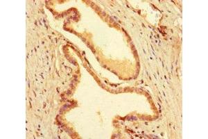 Immunohistochemistry of paraffin-embedded human prostate cancer using ABIN7155782 at dilution of 1:100 (MEIS1 Antikörper  (AA 1-90))
