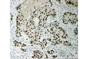 IHC-P: p63 antibody testing of human esophageal squamous cell carcinoma tissue (TCP1 alpha/CCTA Antikörper  (AA 82-98))