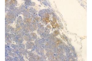 LAT Antibody at 1/100 staining human thymoma by IHC-P. (LAT Antikörper  (C-Term))