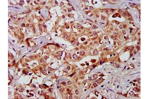 IHC image of ABIN7154482 diluted at 1:1000 and staining in paraffin-embedded human liver cancer performed on a Leica BondTM system. (GAS2 Antikörper  (AA 1-141))