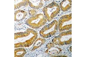 Immunohistochemical analysis of BID staining in human colon cancer formalin fixed paraffin embedded tissue section. (BID Antikörper)