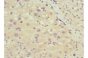 Immunohistochemistry of paraffin-embedded human liver cancer using ABIN7172635 at dilution of 1:100 (SOX5 Antikörper  (AA 1-120))