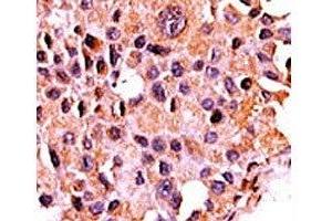 IHC analysis of FFPE human breast carcinoma tissue stained with the Calcineurin antibody (CAN Antikörper  (AA 21-51))
