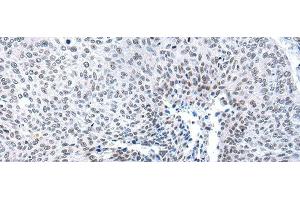 Immunohistochemistry of paraffin-embedded Human lung cancer tissue using MORC2 Polyclonal Antibody at dilution of 1:25(x200) (MORC2 Antikörper)