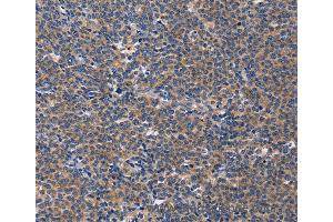Immunohistochemistry of Human liver cancer using CD5L Polyclonal Antibody at dilution of 1:40 (CD5L Antikörper)
