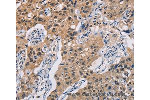 Immunohistochemistry of Human lung cancer using TLR3 Polyclonal Antibody at dilution of 1:50 (TLR3 Antikörper)