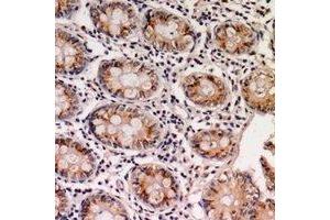 Immunohistochemical analysis of EPS8L1 staining in human colon cancer formalin fixed paraffin embedded tissue section.