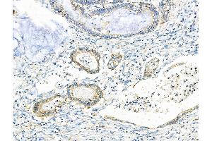 ABIN6259590 and ABIN6275930 at 1/100 staining Human gastric cancer by IHC-P. (BUD31 Antikörper  (N-Term))