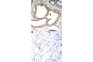 Immunohistochemical staining of human breast cancer tissue by Nfkbie (phospho S22) polyclonal antibody  without blocking peptide (A) or preincubated with blocking peptide (B) under 1:50-1:100 dilution. (NFKBIE Antikörper  (pSer22))