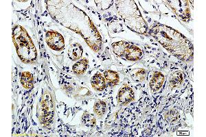 Formalin-fixed and paraffin embedded human colon carcinoma labeled with Rabbit Anti-JAK2 Polyclonal Antibody (ABIN730513), Unconjugated 1:200 followed by conjugation to the secondary antibody and DAB staining (CD38 Antikörper  (AA 81-180))