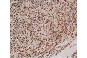 IHC-P analysis of Human Rectum Cancer Tissue, with DAB staining. (S100P Antikörper  (AA 1-95))