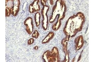 Formalin-fixed, paraffin-embedded human prostate carcinoma stained with Cytokeratin 18 antibody (KRT18/834). (Cytokeratin 18 Antikörper)
