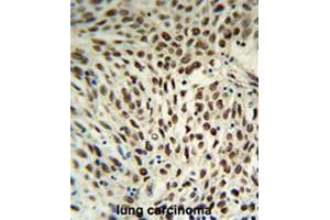 SNRPD3 Antibody (C-term) IHC analysis in formalin fixed and paraffin embedded human lung carcinoma followed by peroxidase conjugation of the secondary antibody and DAB staining. (SNRPD3 Antikörper  (C-Term))