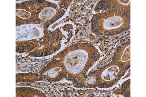 Immunohistochemistry of Human colon cancer using GJB4 Polyclonal Antibody at dilution of 1:40 (GJB4 Antikörper)