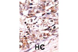 Formalin-fixed and paraffin-embedded human hepatocellular carcinoma tissue reacted with DUSP13 polyclonal antibody  , which was peroxidase-conjugated to the secondary antibody, followed by AEC staining. (DUSP13 Antikörper  (N-Term))