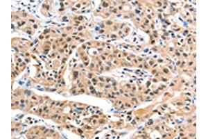 The image on the left is immunohistochemistry of paraffin-embedded Human liver cancer tissue using ABIN7129182(DDX4 Antibody) at dilution 1/20, on the right is treated with fusion protein. (DDX4 Antikörper)