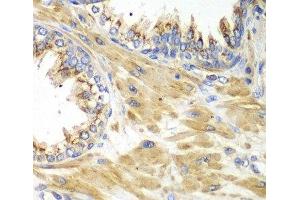Immunohistochemistry of paraffin-embedded Human prostate using PICK1 Polyclonal Antibody at dilution of 1:100 (40x lens). (PICK1 Antikörper)