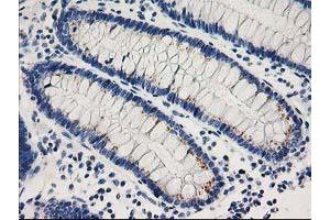 Immunohistochemical staining of paraffin-embedded Adenocarcinoma of Human breast tissue using anti-CDK2 mouse monoclonal antibody. (CDK2 Antikörper)