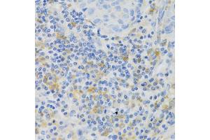 Immunohistochemistry of paraffin-embedded human lung cancer using PAK1 Antibody (ABIN5971674) at dilution of 1/100 (40x lens). (PAK1 Antikörper)