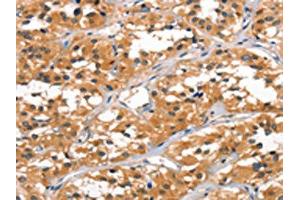 The image on the left is immunohistochemistry of paraffin-embedded Human thyroid cancer tissue using ABIN7189781(ALOX15 Antibody) at dilution 1/60, on the right is treated with synthetic peptide. (ALOX15 Antikörper)