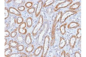 Formalin-fixed, paraffin-embedded human Renal Cell Carcinoma stained with CD61 Rabbit Recombinant Monoclonal Antibody (ITGB3/2166R). (Rekombinanter Integrin beta 3 Antikörper  (AA 385-490))