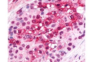Anti-CXCR6 antibody IHC of human Breast, Carcinoma. (CXCR6 Antikörper  (Cytoplasmic Domain))