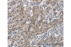 Immunohistochemistry of Human gastric cancer using SMAD9 Polyclonal Antibody at dilution of 1:30 (SMAD9 Antikörper)