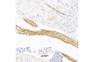 Immunohistochemistry of paraffin-embedded human esophageal cancer using VASH1 antibody (ABIN6290544) at dilution of 1:100 (20x lens).
