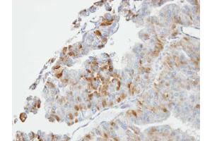 IHC-P Image Immunohistochemical analysis of paraffin-embedded GSTA2 xenograft, using GSTO1, antibody at 1:100 dilution. (GSTO1 Antikörper)