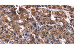 Immunohistochemistry of paraffin-embedded Human liver cancer tissue using NFATC3 Polyclonal Antibody at dilution 1:50 (NFATC3 Antikörper)