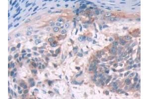 Detection of FLNa in Human Skin cancer Tissue using Polyclonal Antibody to Filamin A Alpha (FLNa)