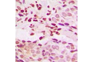 Immunohistochemical analysis of JUNB (pS259) staining in human breast cancer formalin fixed paraffin embedded tissue section.