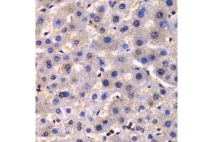 Immunohistochemistry of paraffin-embedded human liver cancer using IKBKG antibody at dilution of 1:100 (400x lens). (IKBKG Antikörper)