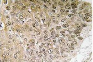 Immunohistochemistry (IHC) analyzes of PI 3-kinase p85alpha antibody in paraffin-embedded human lung carcinoma tissue. (PIK3R1 Antikörper)