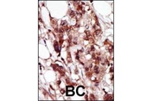 Formalin-fixed and paraffin-embedded human cancer tissue reacted with the primary antibody, which was peroxidase-conjugated to the secondary antibody, followed by AEC staining. (BRD4 Antikörper  (C-Term))