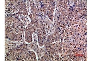 Immunohistochemical analysis of paraffin-embedded human-lung-cancer, antibody was diluted at 1:200 (IFNAR1 Antikörper  (AA 300-350))