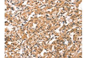 The image on the left is immunohistochemistry of paraffin-embedded Human thyroid cancer tissue using ABIN7190421(CYP46A1 Antibody) at dilution 1/15, on the right is treated with synthetic peptide. (CYP46A1 Antikörper)