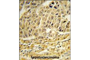 Formalin-fixed and paraffin-embedded human hepatocarcinoma reacted with CCNB1IP1 Antibody , which was peroxidase-conjugated to the secondary antibody, followed by DAB staining. (CCNB1IP1 Antikörper  (C-Term))