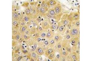 IHC analysis of FFPE human hepatocarcinoma tissue stained with Connective Tissue Growth Factor antibody (CTGF Antikörper  (AA 315-349))