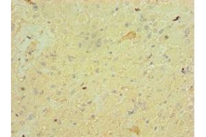 Immunohistochemistry of paraffin-embedded human glioma using ABIN7152828 at dilution of 1:100 (FGF9 Antikörper  (AA 1-208))