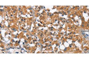 Immunohistochemistry of paraffin-embedded Human thyroid cancer using ARMCX2 Polyclonal Antibody at dilution of 1:40 (ARMCX2 Antikörper)
